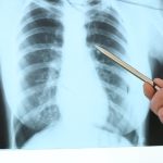 Pulmonary Edema Sai Hospital Haldwani