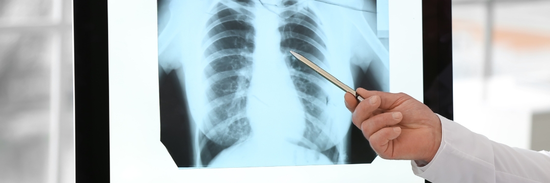 Pulmonary Edema Sai Hospital Haldwani