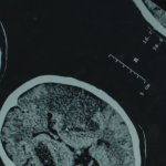 how to perform a neurological assessment | sai hospital haldwani