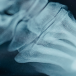 What Are the Early Signs of Orthopedic Issues? | Sai Hospital, Haldwani