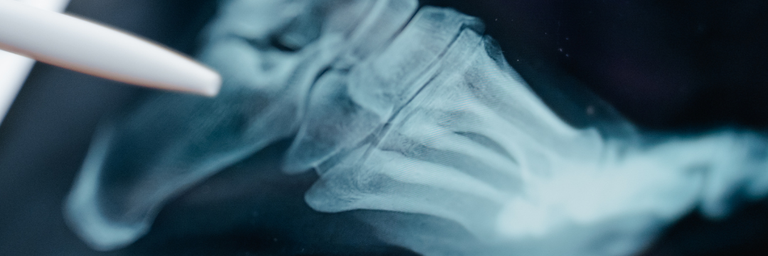 What Are the Early Signs of Orthopedic Issues? | Sai Hospital, Haldwani